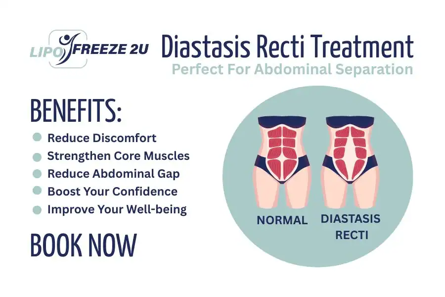 Benefits of body toning treatment Potters Bar for Diastasis recti