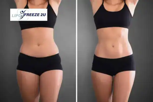 How Can LIPO FREEZE 2U Support Your Post-Pregnancy Body Recovery Potters Bar?