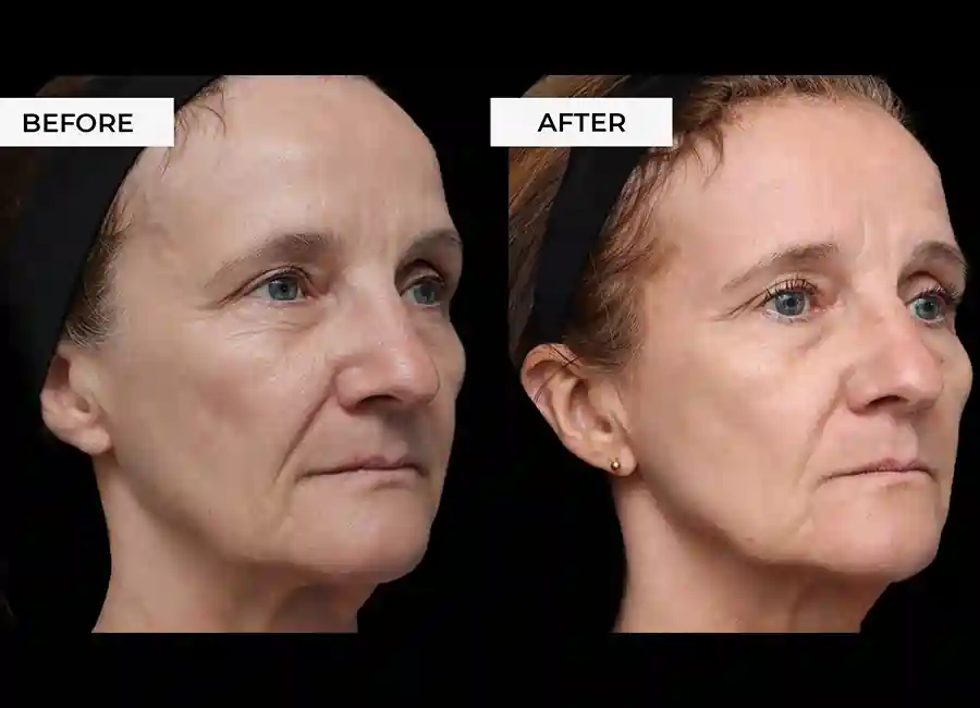 How Many RF Microneedling Sessions Will You Need to See a Difference Potters Bar?
