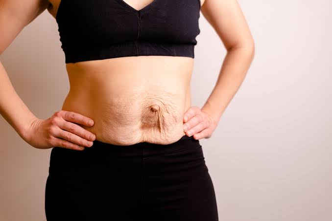 Is Surgery Really the Only Way to Repair Diastasis Recti Potters Bar?